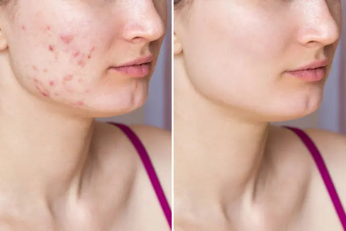 Microneedling - micro infusion - Pure&Glam Pure&Glam